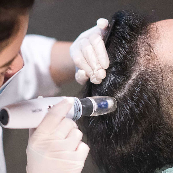 Mesotherapy for Hair