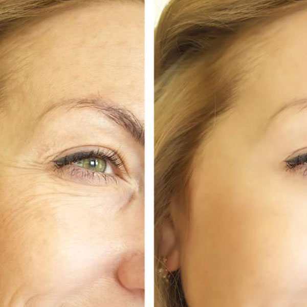 poly-new Polylactic Acid Fillers Treatment