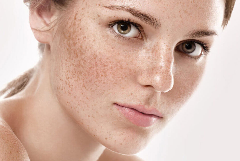 Hyperpigmentation Hyperpigmentation Treatment