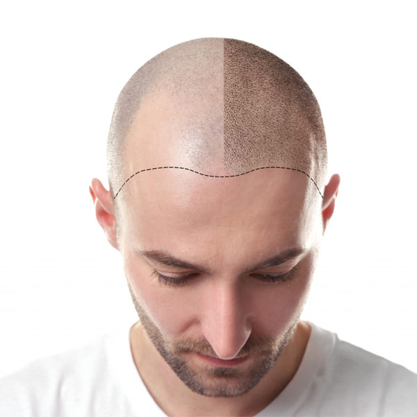 Micropigmentation Micro Pigmentation Treatment in Delhi