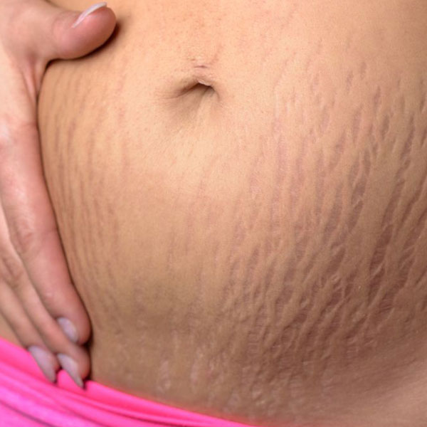 Stretch-Marks Stretch Marks treatment