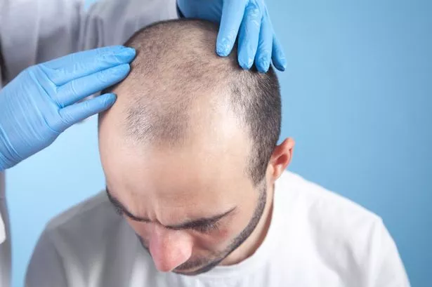Hair Transplantation