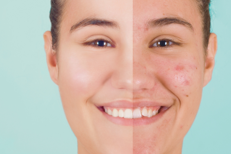 Acne Treatment in India