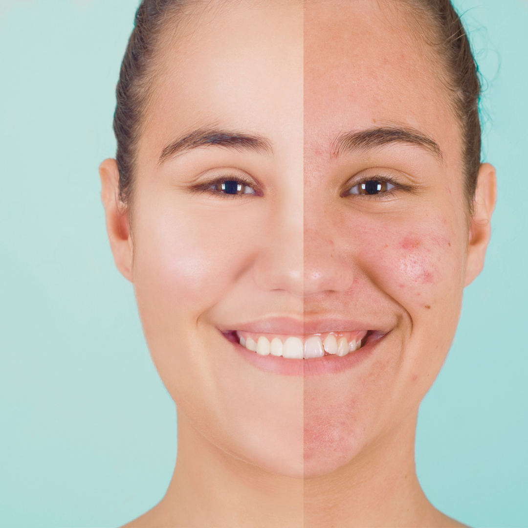 Acne Treatment in India