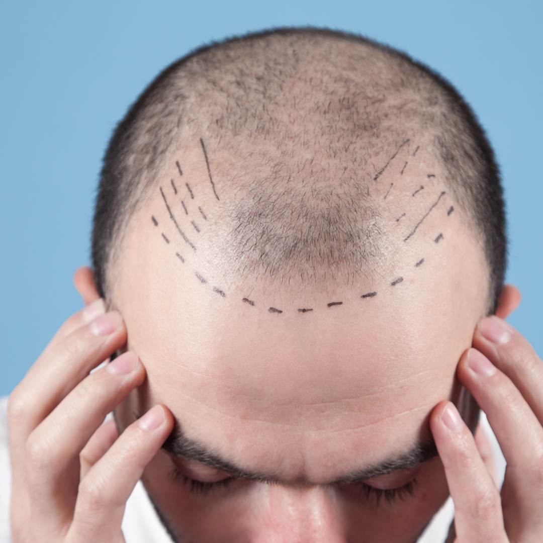 Hair Transplant Surgery